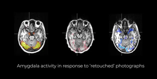 Amygdala activity in response to “retouched” photographs