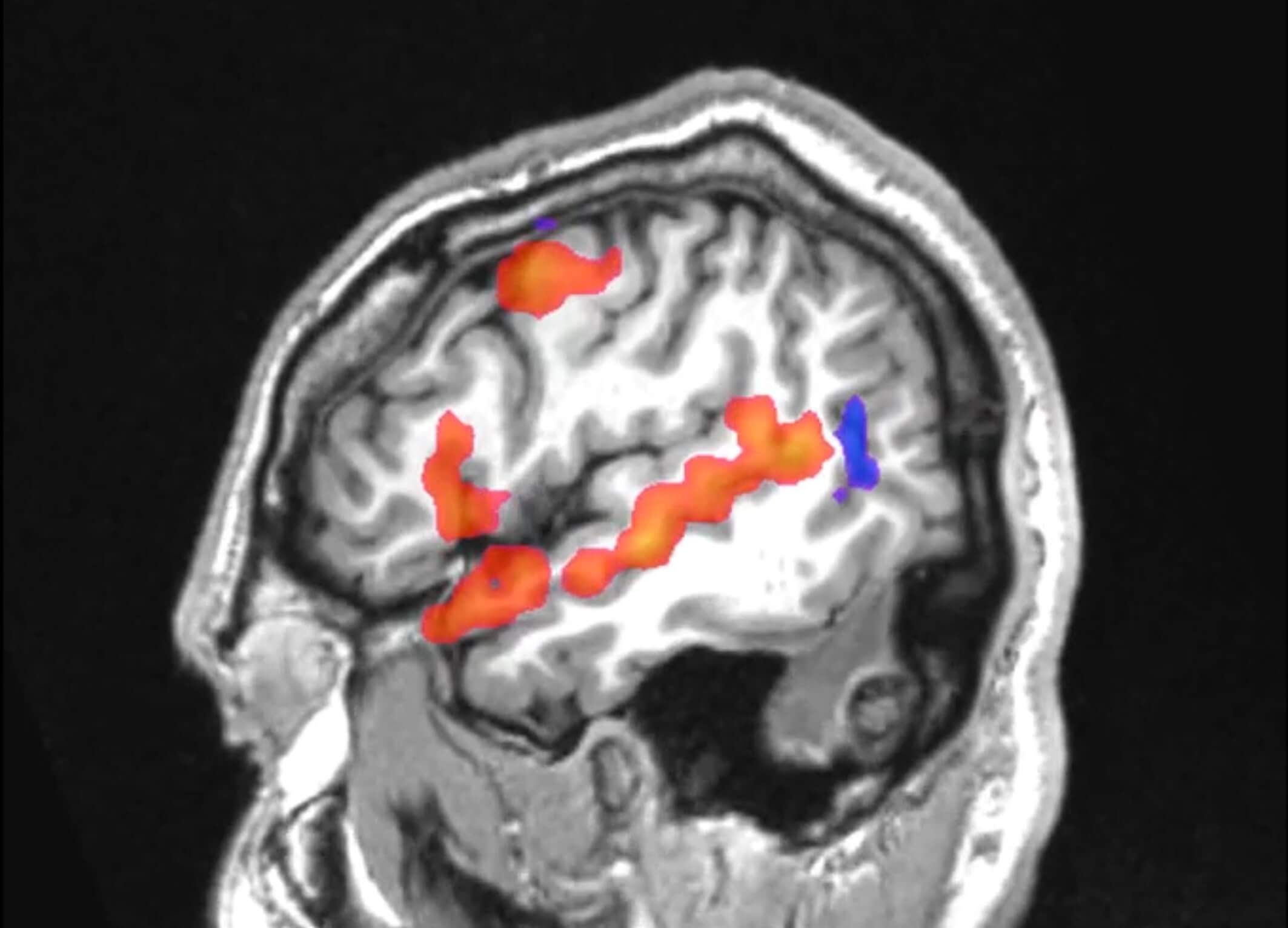 Axial MRI scan of a human brain